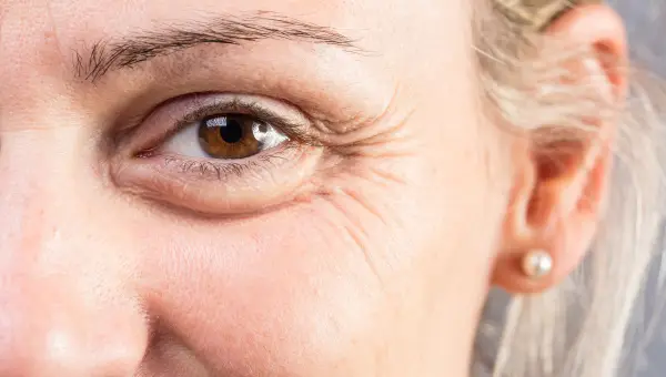 rides autour des yeux