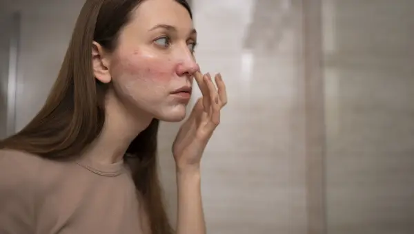 œdèmes et brûlures du visage après lifting RF